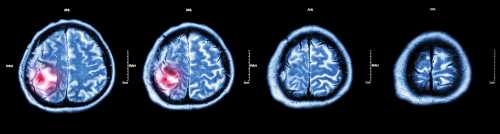 Опухоль головного мозга: основные симптомы